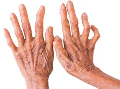 आज ७०औँ विश्व कुष्ठरोग दिवस: मधेसमा सबैभन्दा धेरै कुष्ठरोगी