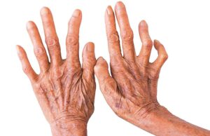 आज ७०औँ विश्व कुष्ठरोग दिवस: मधेसमा सबैभन्दा धेरै कुष्ठरोगी