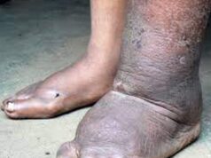 हात्तीपाइलेका बिरामी भेटिएपछि लमजुङमा औषधि वितरण अभियान सुरु