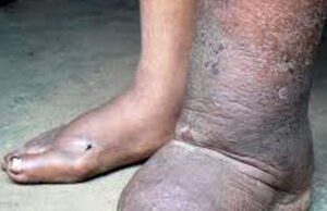 हात्तीपाइलेका बिरामी भेटिएपछि लमजुङमा औषधि वितरण अभियान सुरु