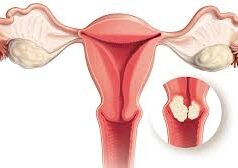 लेलेमा पाठेघरको मुखको क्यान्सर र स्तन क्यान्सर उपचार शिविर