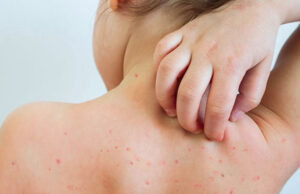 दादुराबाट १६ जिल्ला एक हजारभन्दा बढी मानिस सङ्क्रमित