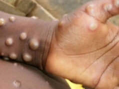 नेपालमा पहिलो पटक देखियो मङ्कीपक्स, ६० वर्षीया एक जना महिलामा पुष्टि