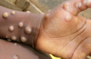 नेपालमा पहिलो पटक देखियो मङ्कीपक्स, ६० वर्षीया एक जना महिलामा पुष्टि