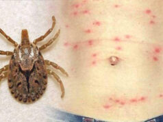 त्रियुगा, बेलका र चौदण्डीगढी नगरपालिकामा स्क्रब टाइफसको सङ्क्रमण बढ्दै