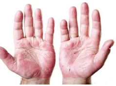 १४ वर्ष मुनिका १ सय ८१ जना कुष्ठरोगका बिरामी